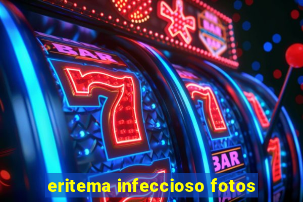 eritema infeccioso fotos
